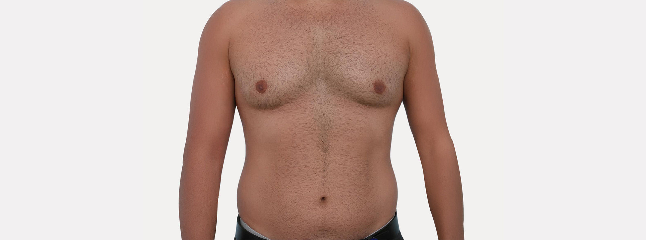 A man's chest before receiving laser hair removal on the abdomen.