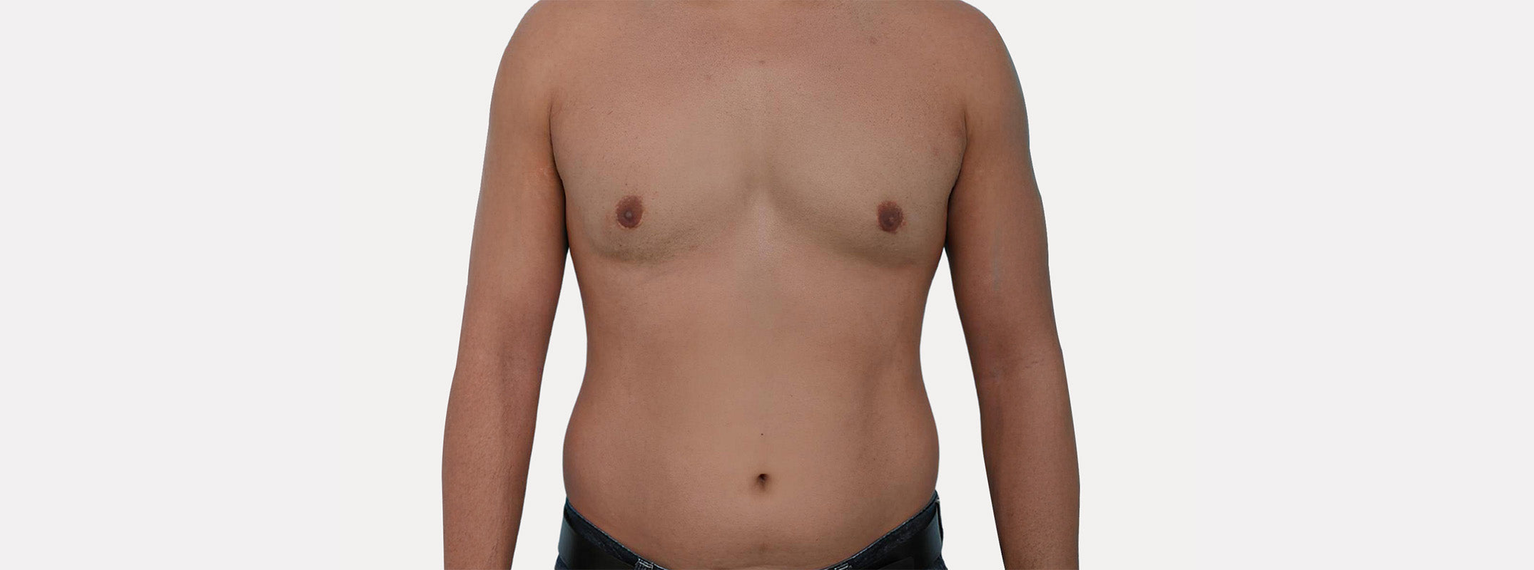 A man's chest after receiving laser hair removal on the abdomen.