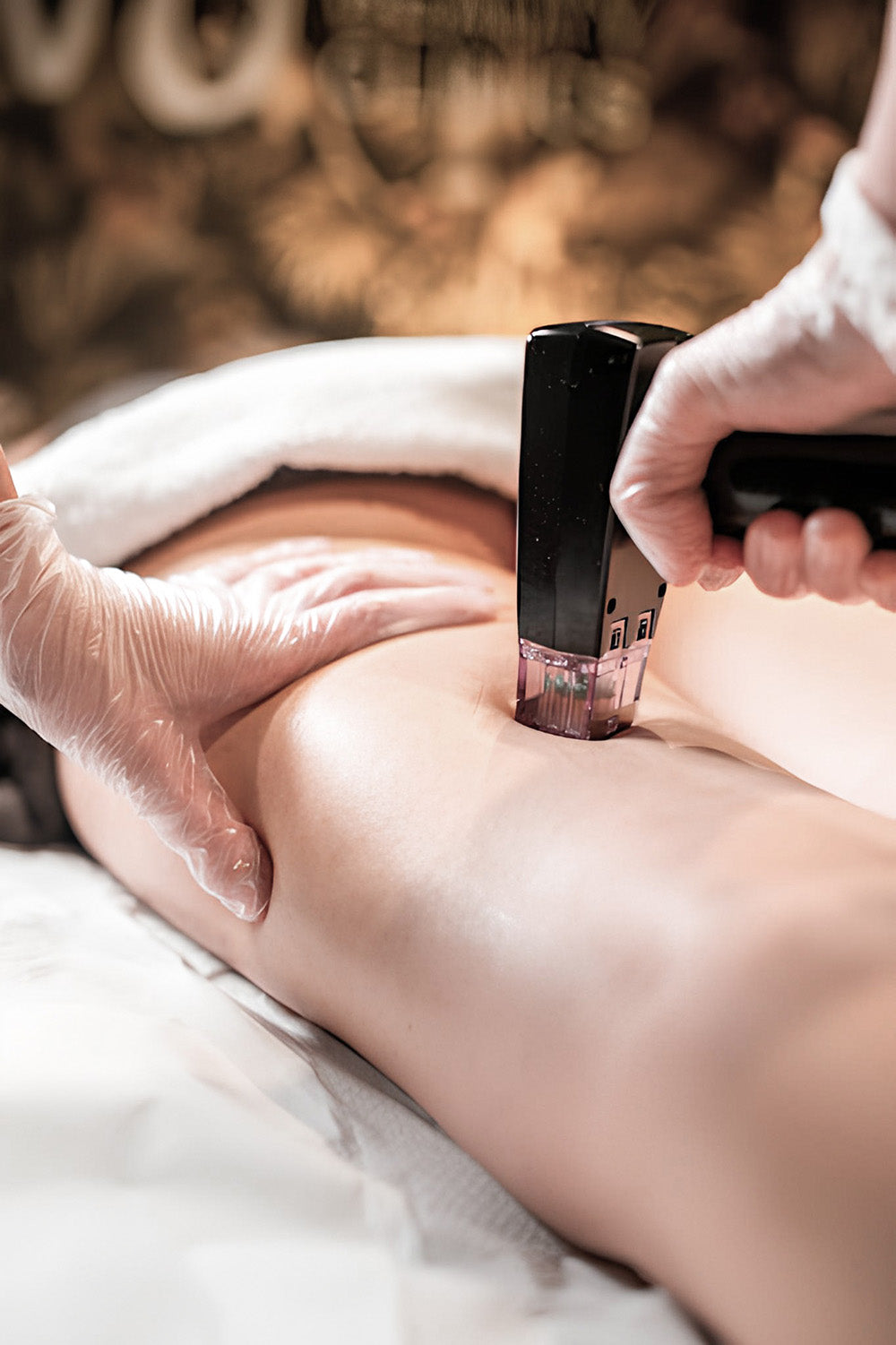 A woman receiving a cosmetic treatment on her thigh.