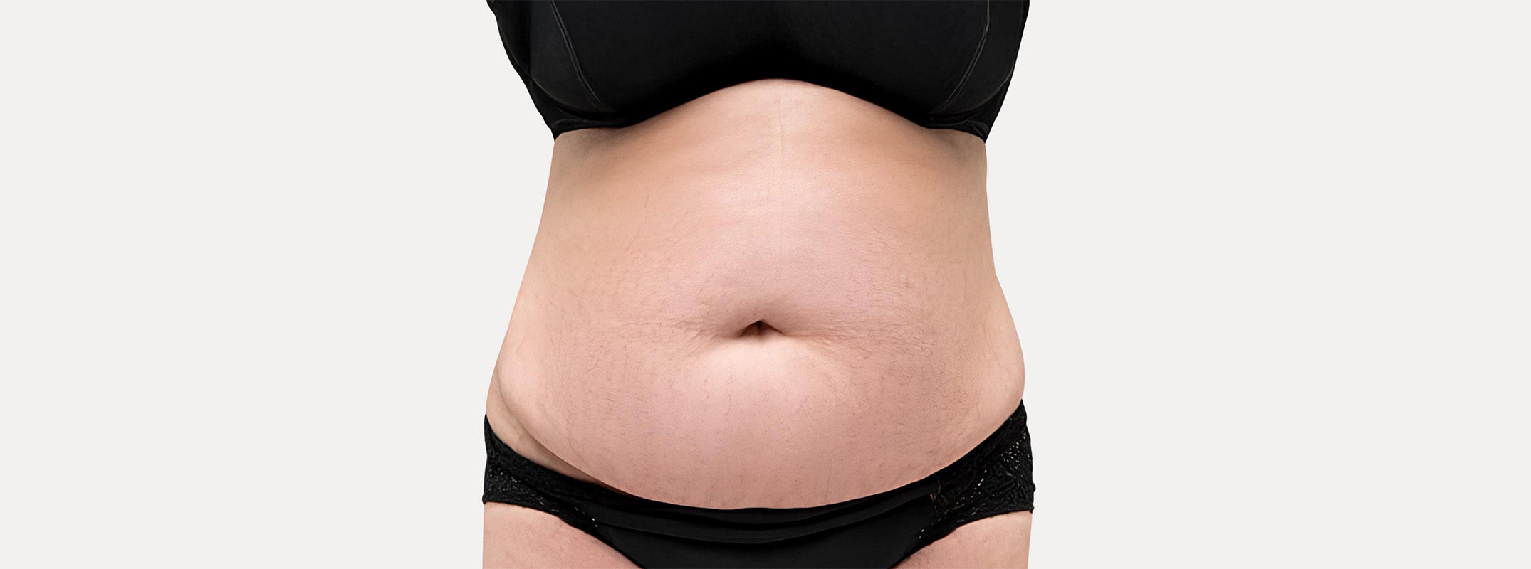 A woman's abdomen after receiving an Afrodita skin treatment.
