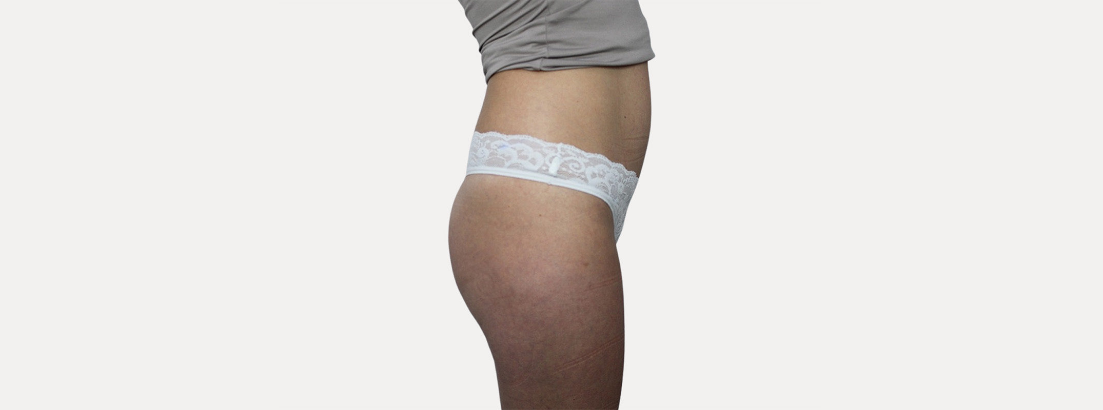 A woman's butt after receiving a non surgical butt lift.