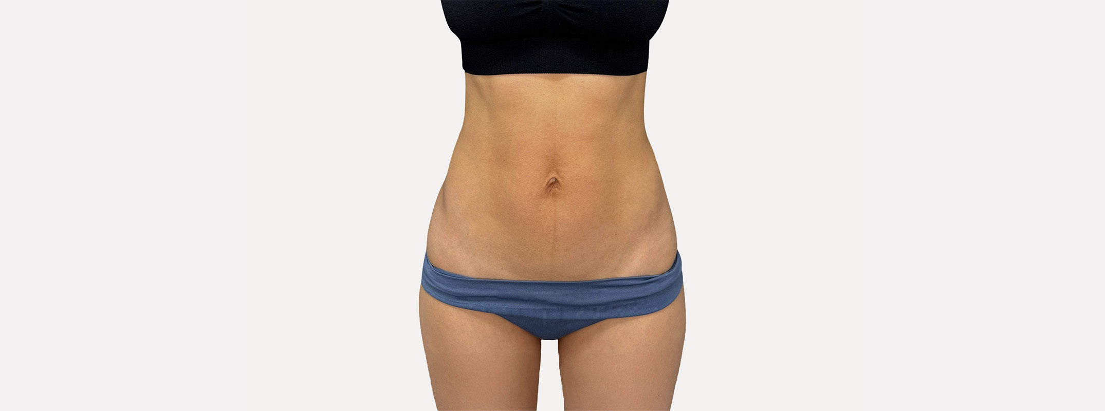 Abdomen of a woman after receiving a post-partum recovery treatment.
