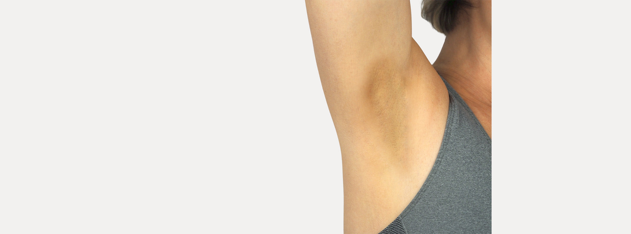 A woman's armpit before receiving a Diamond Sphell treatment.