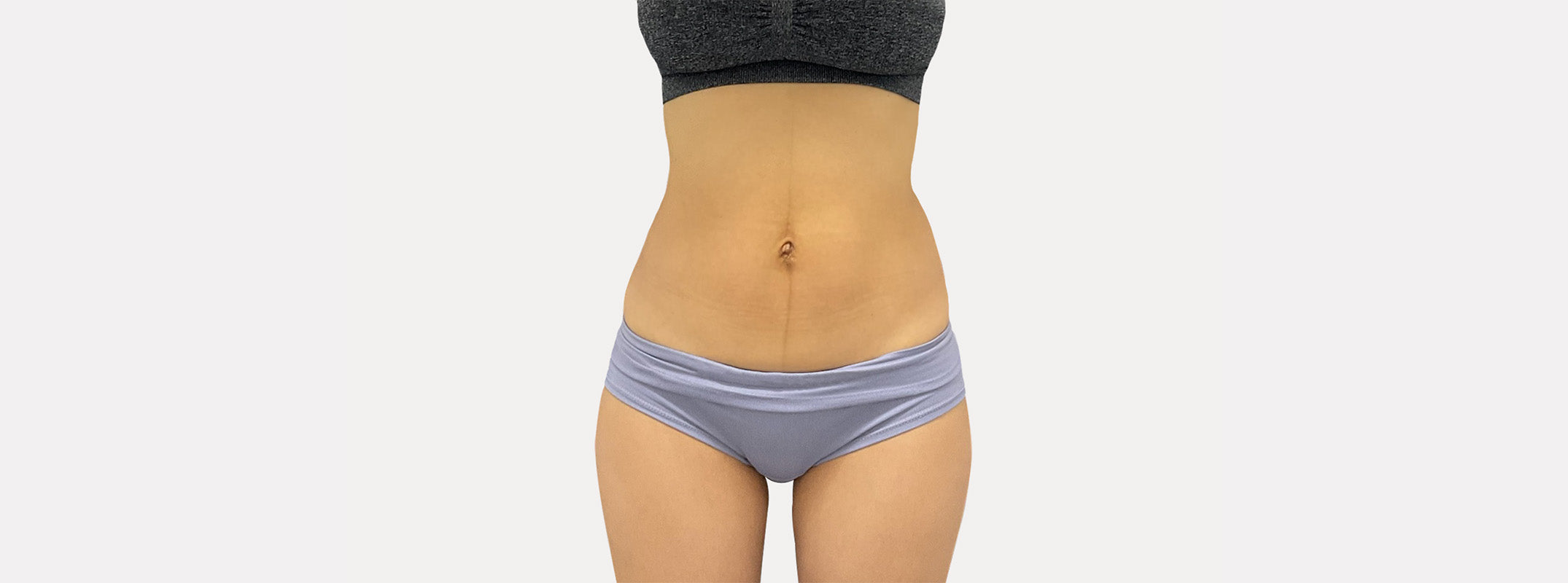 Abdomen of a woman before receiving a post-partum recovery treatment.