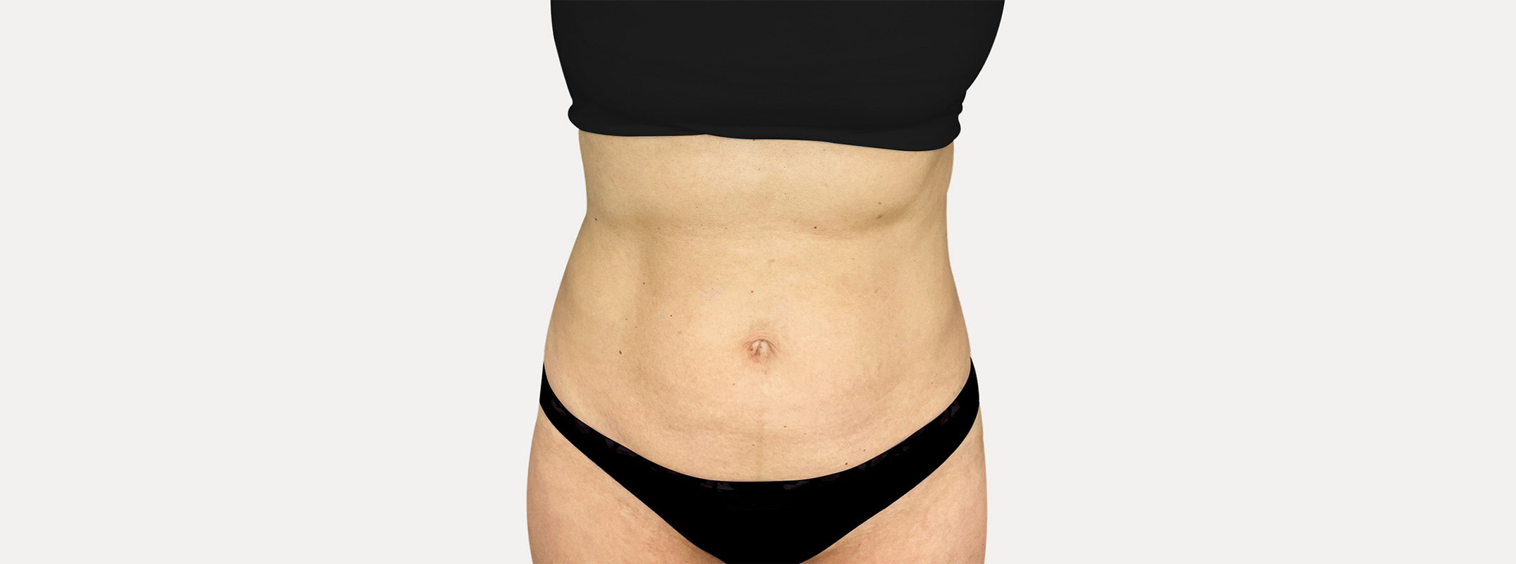 A woman's abdomen before receiving a skin tightening.