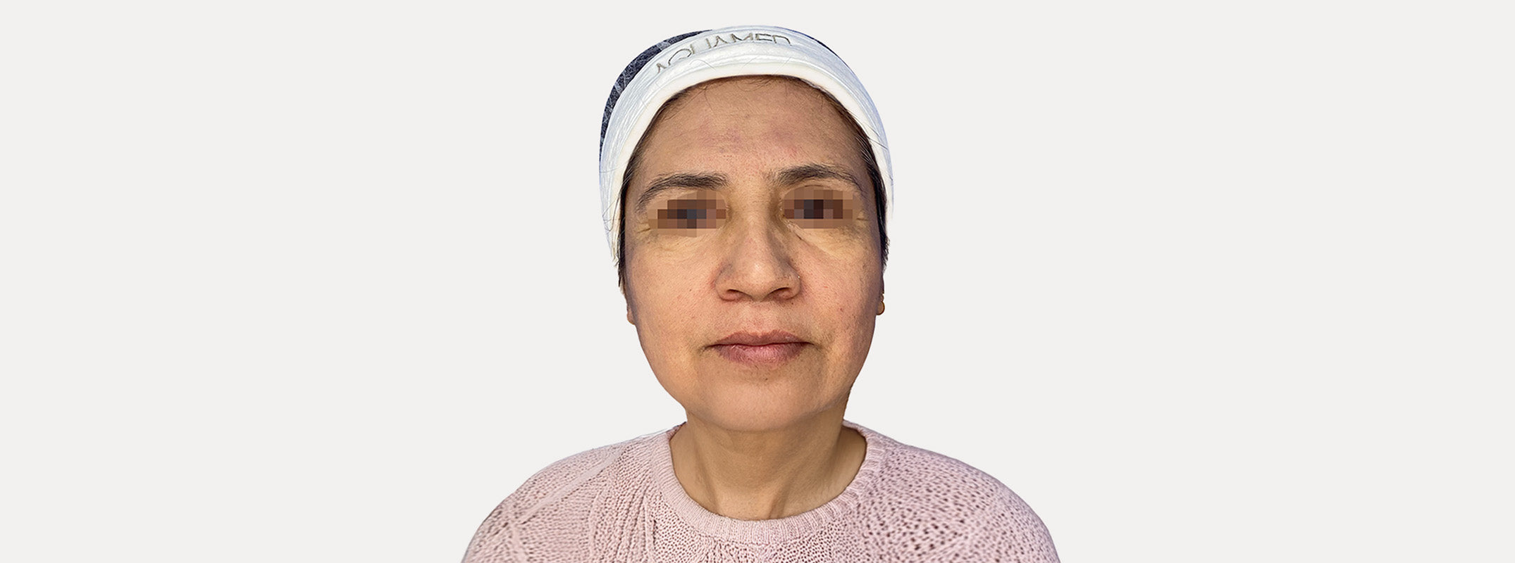 Close up of a woman's face after a sphell facial treatment.