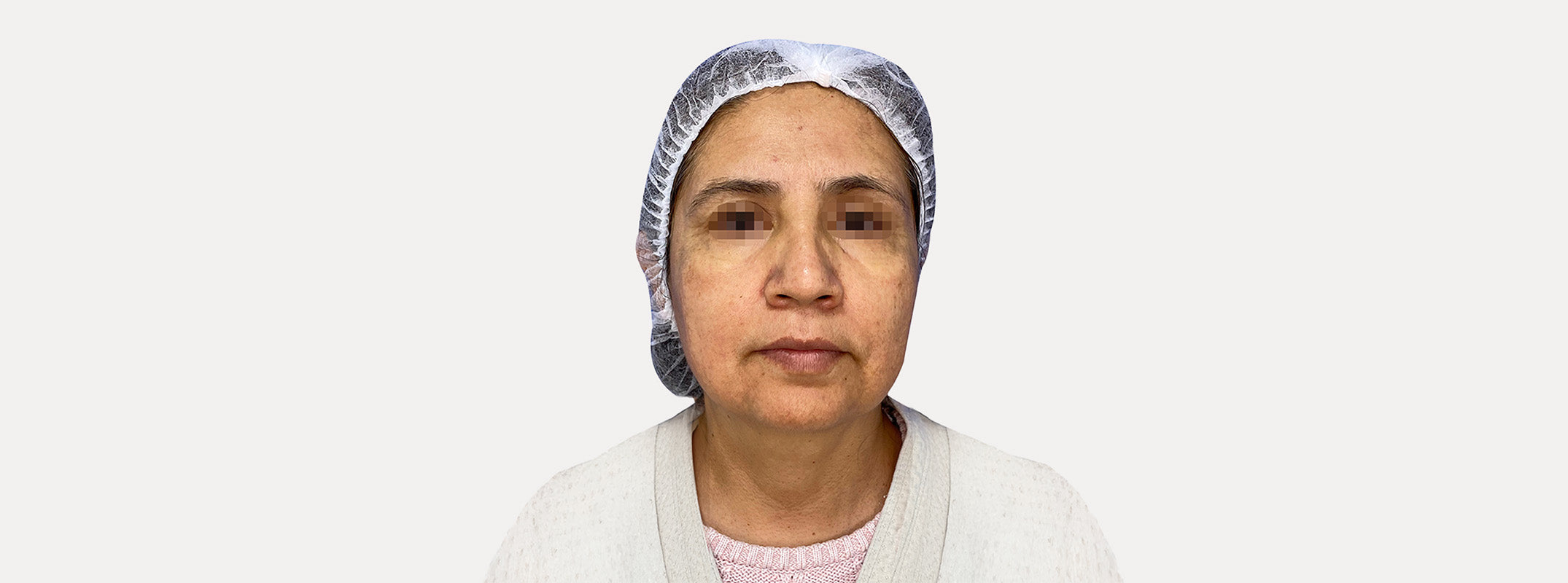 Close up of a woman's face before a sphell facial treatment.