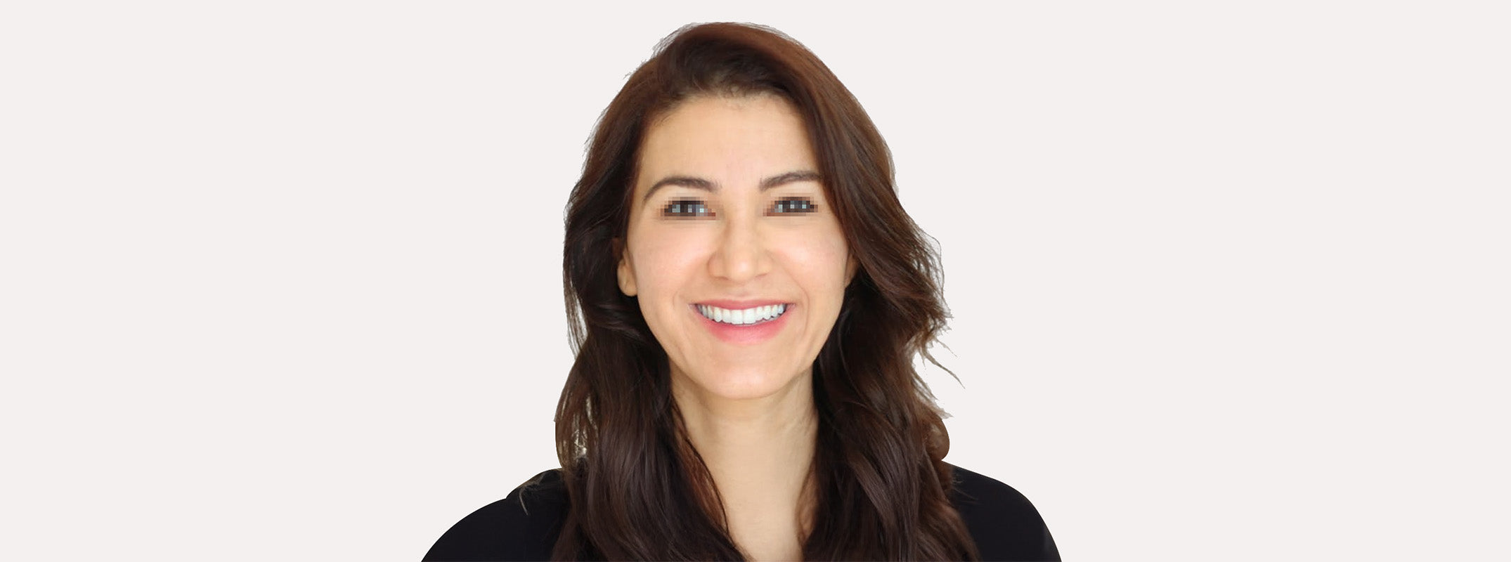 A woman's face after receiving a smartlifting RF treatment.