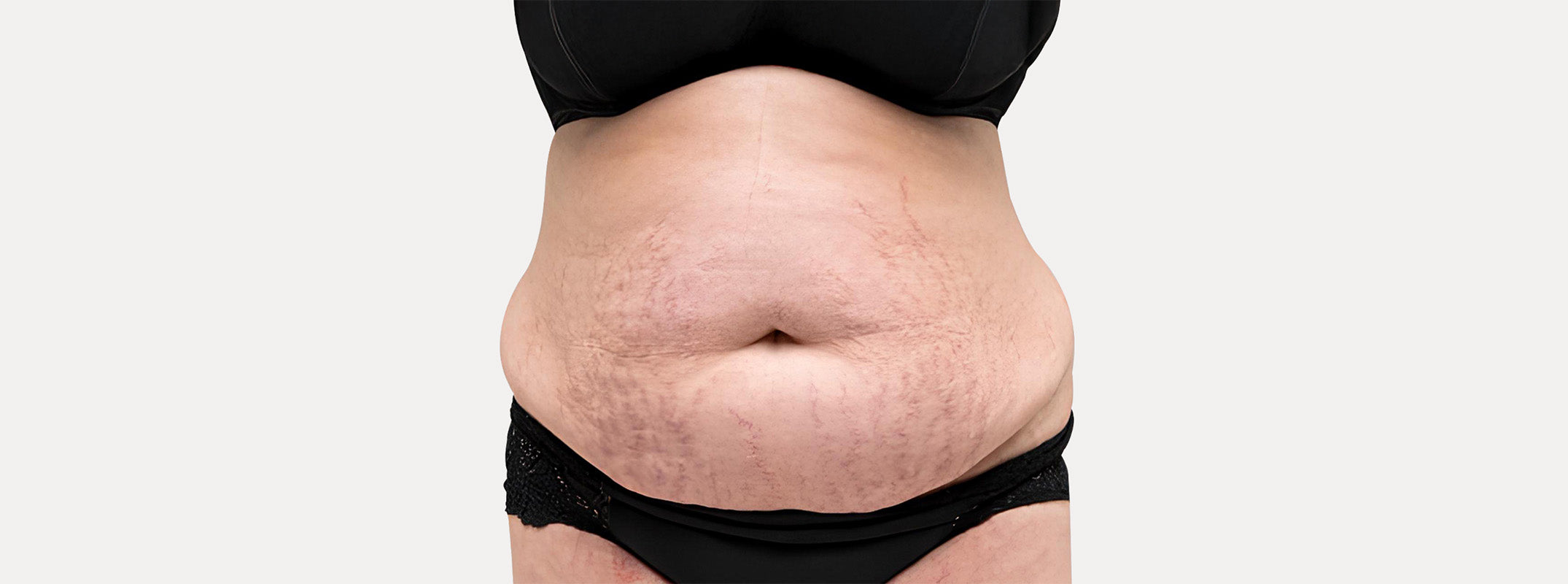 A woman's abdomen before receiving an Afrodita skin treatment. 