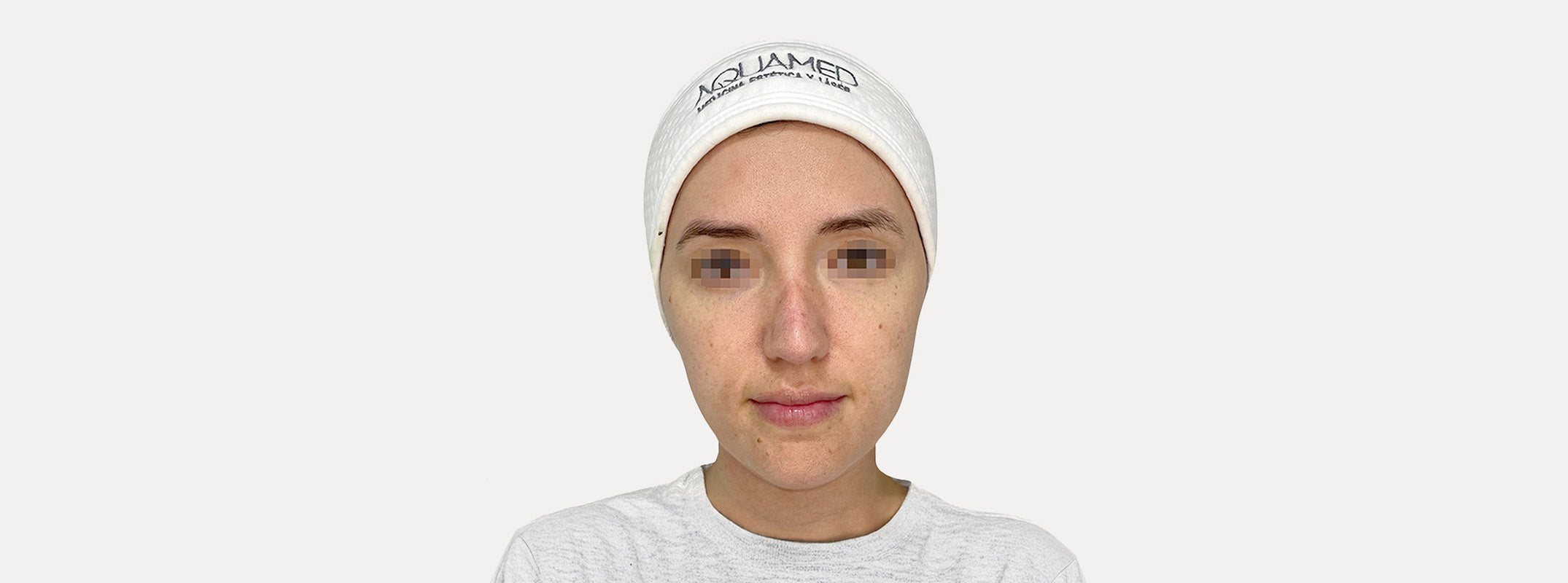 A woman's face before receiving a green detox facial. 