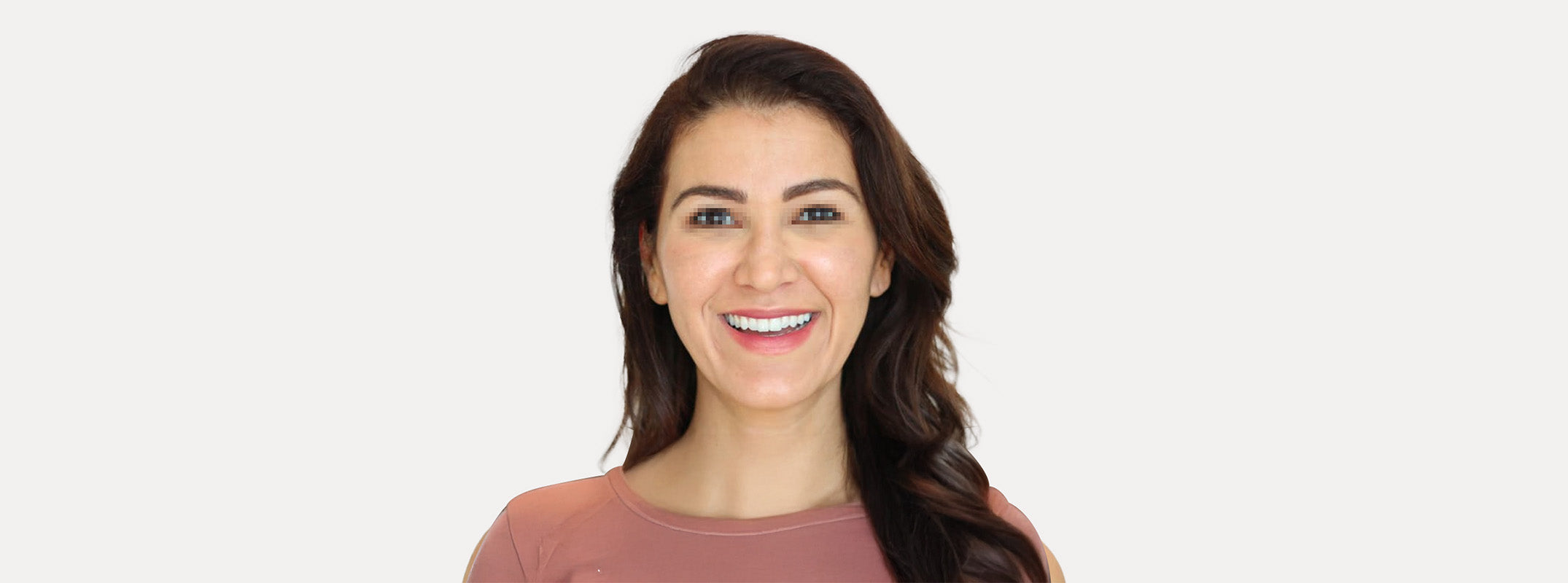 A woman's face before receiving an rf skin tightening.